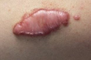 mederma for wrinkles, keloids & age spots