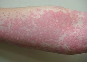 baking soda for hives